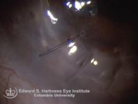 Tight sutures after penetrating keratoplasty